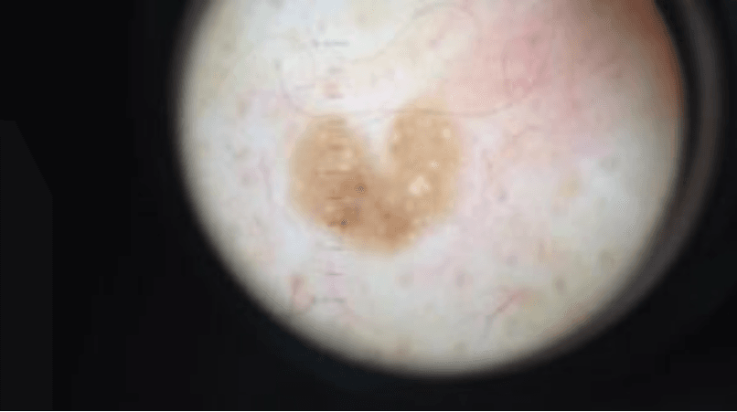 Dermatologie pour les médecins généralistes: améliorer le diagnostic en tant que premier recours